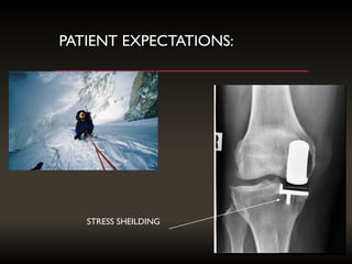 PATIENT EXPECTATIONS:
STRESS SHEILDING
 