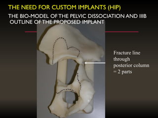 THE BIO-MODEL OF THE PELVIC DISSOCIATION AND IIIB
OUTLINE OF THE PROPOSED IMPLANT
Fracture line
through
posterior column
= 2 parts
THE NEED FOR CUSTOM IMPLANTS (HIP)
 