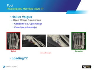 31
Foot
Physiologically Motivated Inputs ??
• Hallux Valgus
– Open Wedge Osteotomies
• Osteotomy Cut, Open Wedge
• Place Spacer/Implant(s)
• Loading??
www.arthrex.com
Defect Correction
 