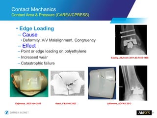 37
Contact Mechanics
Contact Area & Pressure (CAREA/CPRESS)
• Edge Loading
– Cause
•Deformity, V/V Malalignment, Congruency
– Effect
– Point or edge loading on polyethylene
– Increased wear
– Catastrophic failure
Easley, JBJS Am 2011;93:1455-1468
Espinosa, JBJS Am 2010 Laflamme, AOFAS 2012Assal, F&A Intl 2003
 