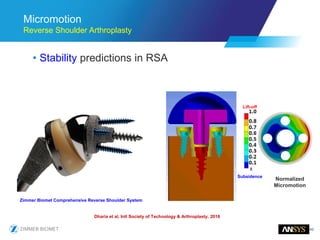 43
Micromotion
Reverse Shoulder Arthroplasty
• Stability predictions in RSA
Zimmer Biomet Comprehensive Reverse Shoulder System
Subsidence
Lift-off
Normalized
Micromotion
Dharia et al, Intl Society of Technology & Arthroplasty, 2016
 