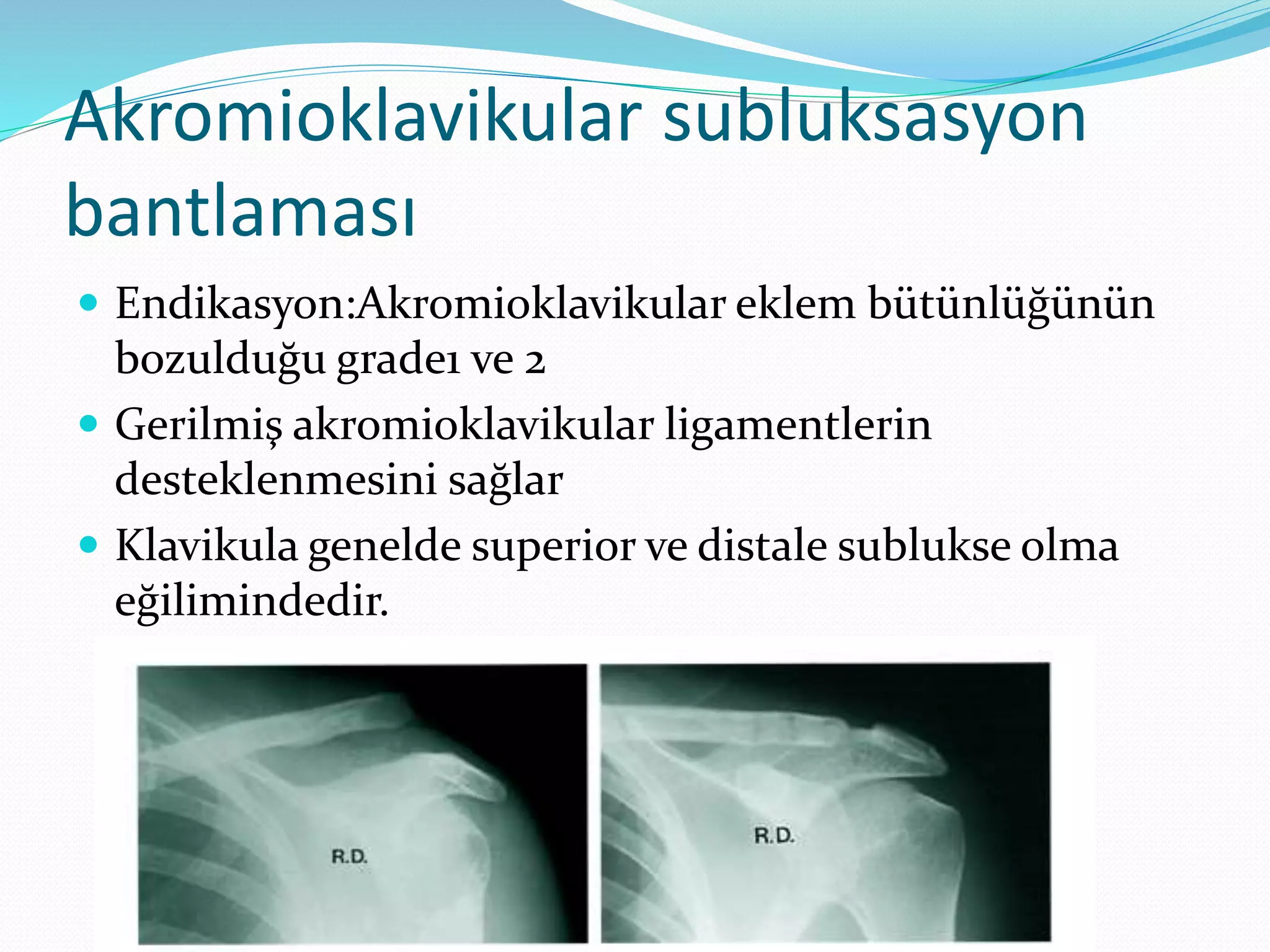 Akromioklavikular subluksasyon 
bantlaması 
 Endikasyon:Akromioklavikular eklem bütünlüğünün 
bozulduğu grade1 ve 2 
 Gerilmiş akromioklavikular ligamentlerin 
desteklenmesini sağlar 
 Klavikula genelde superior ve distale sublukse olma 
eğilimindedir. 
 