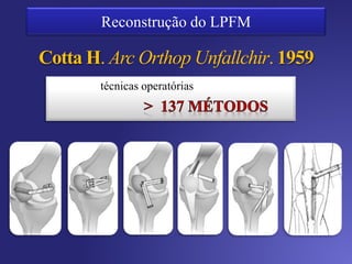 Reconstrução anatômica
– Diminui o excesso de
pressão de contato
Reconstrução não isométrica vs isométrica
Anatomométrico
Quase isométrico entre 0 e 120º
 