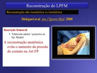 Reconstrução dinâmica
Técnica estática X dinâmica
Dinâmica –
Diminui o excesso de tensão
ou posicionamento incorreto
do enxerto
Inserção femoral
 