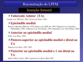 Inserção Patelar
Duas bandas
Tensionamento
BOS – 30 º
BTI – 60 º
 