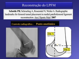 LIGAMENTO SINTÉTICO
(Ellera-Gomes et al em 1992 e Nomura et al em 2000)
T. ADUTOR M.
(Avikainen et al,1993)
SEMITENDÍNEO/ GRACIL
(Muneta et al em 1999; Drez et al em 2001, Nomura em 2005, Ellera-
Gomes em 2002)
RETINÁCULO
( Nomura et al em 2005 e Cossey e Paterson em 2005)
T.QUADRICIPITAL
(Burks & Luckeret al em 1997 e Steensen et al em 2005)
ALOENXERTOS
(Muneta et al 1999)
L. PATELAR
( Camanho et al 2007)
 