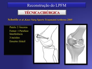 TÉCNICA CIRÚRGICA
Duplo Feixe
Patela: 2 Âncoras
Femur: 1 Parafuso
Interferência
3 incisões
Enxerto:
Semitendíneo
David Sadigursky
 