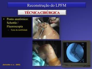 TÉCNICA CIRÚRGICA
Ponto anatômico:
Schottle /
Fluoroscopia
– Teste da mobilidade
David Sadigursky
 