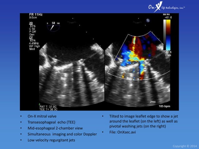 On-X Heart Valve Echocardiography | PPTX | Heart and Cardiovascular ...