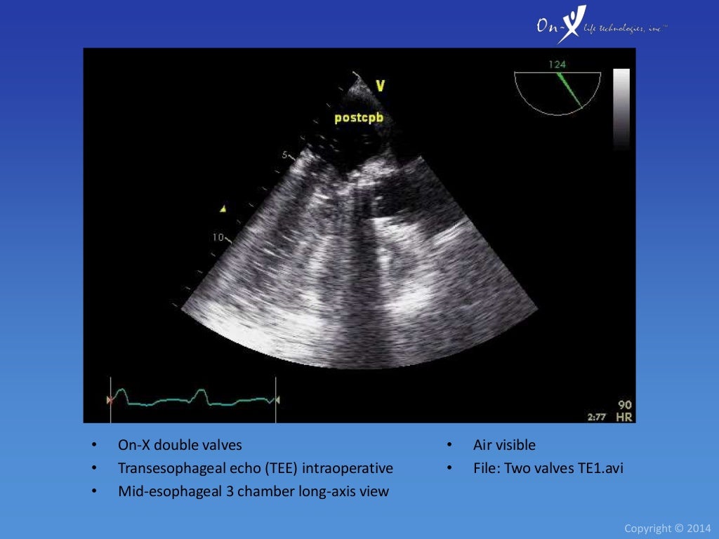 OnX Heart Valve Echocardiography