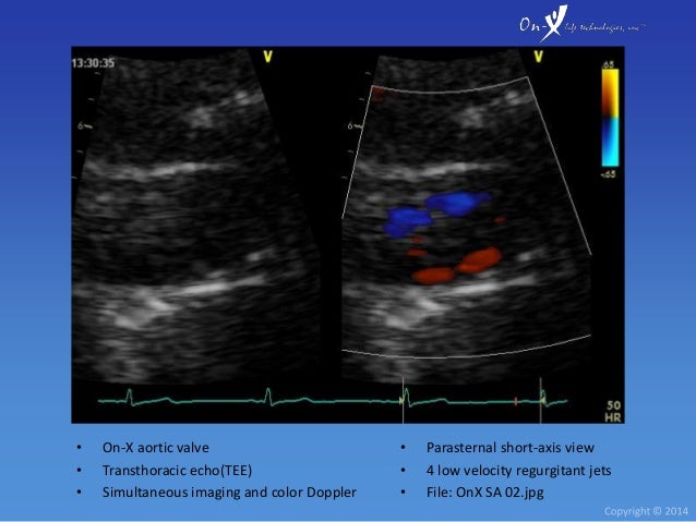 On-X Heart Valve Echocardiography