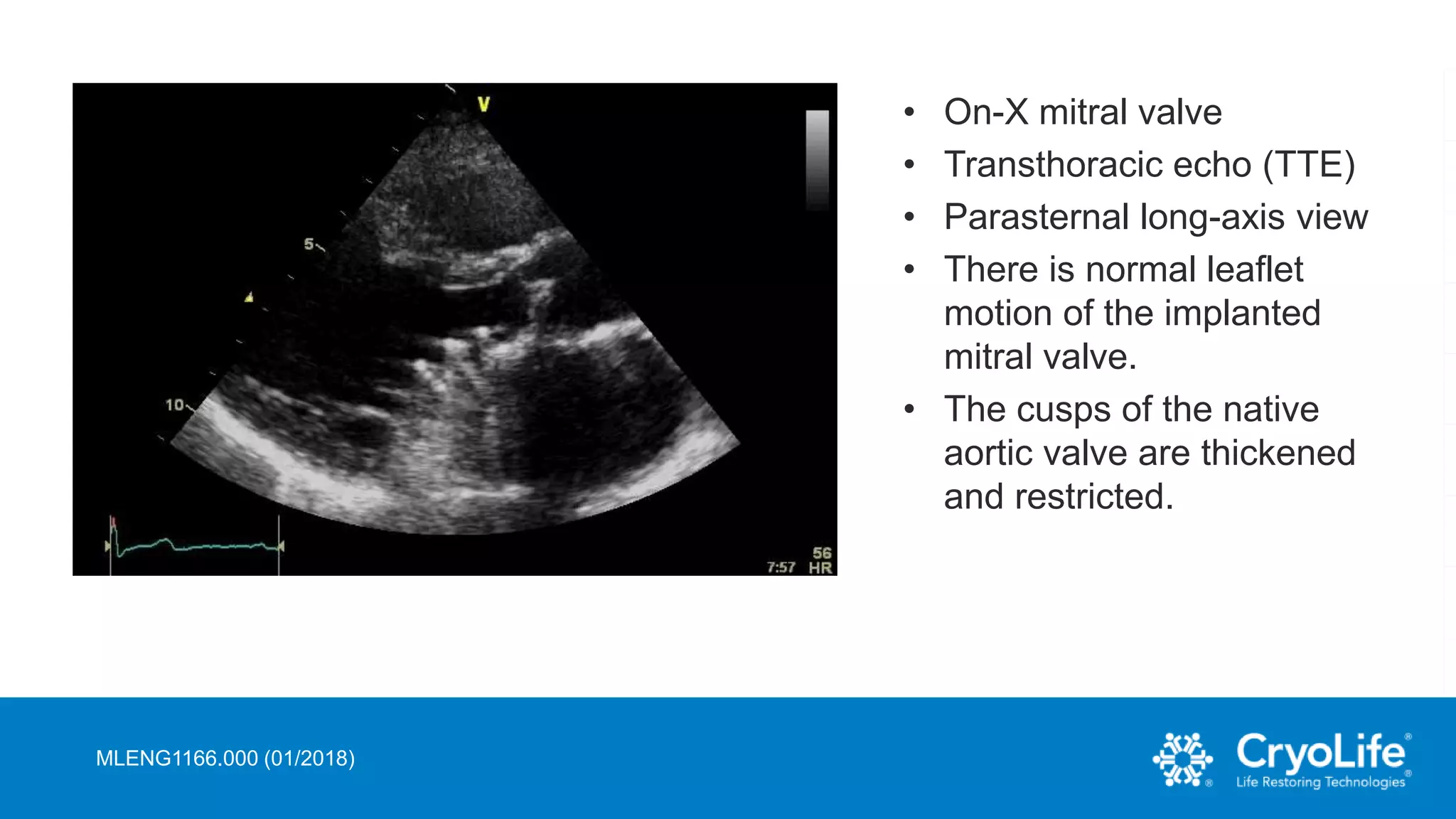 On-X Echocardiography Presentation_MLENG1166.000