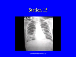 Station 15
dnbpaediatrics.blogspot.in
 