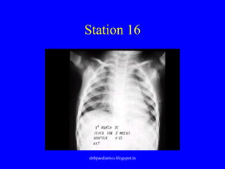 Station 16
dnbpaediatrics.blogspot.in
 