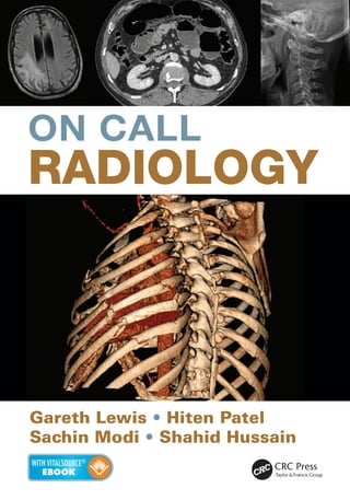 ON CALL
RADIOLOGY
Gareth Lewis • Hiten Patel
Sachin Modi • Shahid Hussain
•	 download the ebook to your computer or access it anywhere with an
internet browser
•	 search the full text and add your own notes and highlights
•	 link through from references to PubMed
ISBN: 978-1-4822-2167-1
9 781482 221671
90000
K22247
MEDICINE
On Call Radiology presents case discussions on the most common and important clinical
emergencies and their corresponding imaging findings encountered on-call. Cases are
divided into thoracic, gastrointestinal and genitourinary, neurological and non-traumatic
spinal, paediatric, trauma, interventional and vascular imaging. Iatrogenic complications are
also discussed.
Each case is presented as a realistic clinical scenario and includes a clinical history
and request for imaging. Multi-modality imaging examples and a case discussion on the
diagnosis and basic management, with emphasis on important radiological findings, are
also presented.
This book combines a case-based discussion format with practical advice on imaging
decision making in the acute setting. It also offers guidance on radiology report writing and
techniques, with a focus on relevant positive and negative findings to pass on to referring
clinicians. On Call Radiology offers invaluable knowledge and practical tips for any
on-call radiologist.
ON CALL
RADIOLOGY
K22247_Cover.indd All Pages 5/21/15 1:52 PM
 