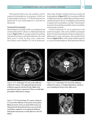 Gastrointestinal and genitourinary imaging 79
This easily identifies calcified renal tract calculi and
hydronephrosis (Figure 2.77). It is sometimes difficult
to differentiate between phleboliths and distal ureteric
calculi in the pelvis; the use of multiplanar reformatting
in sagittal and coronal planes can help. Thickening or
mesentericfatstrandingaroundtheureterscanindicate
recent passage of stones.
Contrast enhanced CT can be performed in the
portal venous phase. This can be useful for assessing for
pelvic/retroperitoneal/gynaecological malignancies,
inflammatory aortic aneurysms, and retroperitoneal
fibrosis (Figure 2.78) as well as large bladder tumours
as a cause for hydronephrosis. Retroperitoneal fibrosis
Ultrasound should be the only modality used for
suspected hydronephrosis in pregnancy, which can
be physiological if present. CT should otherwise be
performed if acute hydronephrosis is detected on
ultrasound.
Computed tomography
Hydronephrosis is readily visible on unenhanced and
contrast enhanced CT, shown as a dilated pelvicalyceal
system (Figure 2.76). In younger patients presenting
with pain/haematuria and hydronephrosis, the most
likely cause is calculi. In these cases, a plain low-
dose kidney–ureter–bladder CT can be performed.
Figure 2.77  Axial image: CT scan of the abdomen
without IV contrast. A rounded, hyperdense calculus is
seen occluding the lumen of the right ureter.
Figure 2.76  Axial image: CT scan of the abdomen
without IV contrast. The right pelvicalyceal system
is dilated compared with the left side. Right renal
­parenchymal volume is preserved. There are mild right
perinephric inflammatory changes.
Figure 2.78  Coronal image: IV contrast enhanced
CT scan of the abdomen in the portal venous phase.
Bilateral ureteric stents are noted. Both ureters are
thickened with abnormal soft tissue seen at the left
renal hlium, suggestive of retroperitoneal fibrosis.
­Subcapsular haematoma is noted adjacent to the left
kidney.
K22247_C002.indd 79 16/05/15 3:07 AM
 