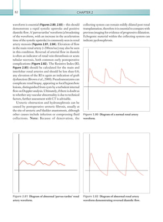 Chapter 282
collecting system can remain mildly dilated post renal
transplantation,thereforeitisessentialtocomparewith
previousimagingforevidenceofprogressivedilatation.
Echogenic material within the collecting system can
indicate pyelonephrosis.
waveform is essential (Figures 2.80, 2.83) – this should
demonstrate a rapid systolic upstroke and positive
diastolicflow.A‘parvustardus’waveform(a broadening
of the waveform, with an increase in the acceleration
time of the systolic upstroke) is commonly seen in renal
artery stenosis (Figures 2.81, 2.84). Elevation of flow
in the main renal artery (200cm/sec) may also be seen
in this condition. Reversal of arterial flow in diastole
is often an indicator of renal vein thrombosis or acute
tubular necrosis, both common early postoperative
complications (Figure 2.82). The Resistive Index (RI;
Figure 2.85) should be calculated for the main and
interlobar renal arteries and should be less than 0.8;
any elevation of the RI is again an indication of graft
dysfunction (Brown et al., 2000). Pseudoaneurysms can
complicate renal biopsy, appearing as focal hypoechoic
lesions, distinguished from cysts by a turbulent internal
flowonDoppleranalysis.Ultimately,ifthereisdoubtas
to whether any vascular abnormality is due to technical
factors, further assessment with CT is advisable.
Ureteric obstruction and hydronephrosis can be
caused by postoperative ureteric fibrosis, usually at
the site of ureteric and bladder anastomosis, although
other causes include infection or compressing fluid
collections. Note: Because of denervation, the
Figure 2.80  Diagram of a normal renal artery
waveform.
Figure 2.82  Diagram of abnormal renal artery
­waveform demonstrating reversed diastolic flow.
Figure 2.81  Diagram of abnormal ‘parvus-tardus’ renal
artery waveform.
K22247_C002.indd 82 16/05/15 3:07 AM
 