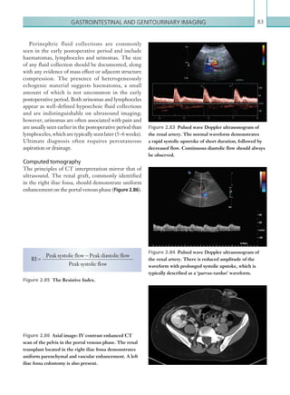 Gastrointestinal and genitourinary imaging 83
Figure 2.83  Pulsed wave Doppler ultrasonogram of
the renal artery. The normal waveform demonstrates
a rapid systolic upstroke of short duration, followed by
decreased flow. Continuous diastolic flow should always
be observed.
Figure 2.84  Pulsed wave Doppler ultrasonogram of
the renal artery. There is reduced amplitude of the
­waveform with prolonged systolic upstoke, which is
­typically described as a ‘parvus-tardus’ waveform.
Perinephric fluid collections are commonly
seen in the early postoperative period and include
haematomas, lymphoceles and urinomas. The size
of any fluid collection should be documented, along
with any evidence of mass effect or adjacent structure
compression. The presence of heterogeneously
echogenic material suggests haematoma, a small
amount of which is not uncommon in the early
postoperative period. Both urinomas and lymphoceles
appear as well-defined hypoechoic fluid collections
and are indistinguishable on ultrasound imaging;
however, urinomas are often associated with pain and
are usually seen earlier in the postoperative period than
lymphoceles, which are typically seen later (5–6 weeks).
Ultimate diagnosis often requires percutaneous
aspiration or drainage.
Computed tomography
The principles of CT interpretation mirror that of
ultrasound. The renal graft, commonly identified
in the right iliac fossa, should demonstrate uniform
enhancement on the portal venous phase (Figure 2.86).
Figure 2.85  The Resistive Index.
RI =
Peak systolic flow − Peak diastolic flow
Peak systolic flow
Figure 2.86  Axial image: IV contrast enhanced CT
scan of the pelvis in the portal venous phase. The renal
transplant located in the right iliac fossa demonstrates
uniform parenchymal and vascular enhancement. A left
iliac fossa colostomy is also present.
K22247_C002.indd 83 16/05/15 3:07 AM
 