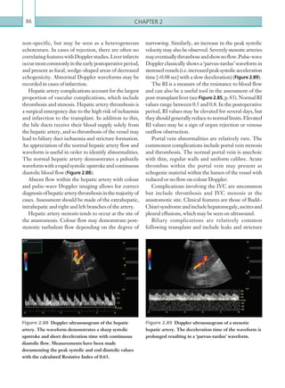 Chapter 286
narrowing. Similarly, an increase in the peak systolic
velocity may also be observed. Severely stenotic arteries
mayeventuallythromboseandshownoflow.Pulse-wave
Doppler classically shows a ‘parvus-tardus’ waveform in
stenosed vessels (i.e. increased peak systolic acceleration
time [0.08 sec] with a slow deceleration) (Figure 2.89).
The RI is a measure of the resistance to blood flow
and can also be a useful tool in the assessment of the
post-transplantliver(see Figure 2.85,p.83).NormalRI
values range between 0.5 and 0.8. In the postoperative
period, RI values may be elevated for several days, but
they should generally reduce to normal limits. Elevated
RI values may be a sign of organ rejection or venous
outflow obstruction.
Portal vein abnormalities are relatively rare. The
commonest complications include portal vein stenosis
and thrombosis. The normal portal vein is anechoic
with thin, regular walls and uniform calibre. Acute
thrombus within the portal vein may present as
echogenic material within the lumen of the vessel with
reduced or no flow on colour Doppler.
Complications involving the IVC are uncommon
but include thrombosis and IVC stenosis at the
anastomotic site. Clinical features are those of Budd–
Chiarisyndromeandincludehepatomegaly,ascitesand
pleural effusions, which may be seen on ultrasound.
Biliary complications are relatively common
following transplant and include leaks and stricture
non-specific, but may be seen as a heterogeneous
echotexture. In cases of rejection, there are often no
correlatingfeatureswithDopplerstudies.Liverinfarcts
occurmostcommonlyintheearlypostoperativeperiod,
and present as focal, wedge-shaped areas of decreased
echogenicity. Abnormal Doppler waveforms may be
recorded in cases of infarction.
Hepatic artery complications account for the largest
proportion of vascular complications, which include
thrombosis and stenosis. Hepatic artery thrombosis is
a surgical emergency due to the high risk of ischaemia
and infarction to the transplant. In addition to this,
the bile ducts receive their blood supply solely from
the hepatic artery, and so thrombosis of the vessel may
lead to biliary duct ischaemia and stricture formation.
An appreciation of the normal hepatic artery flow and
waveform is useful in order to identify abnormalities.
The normal hepatic artery demonstrates a pulsatile
waveformwitharapidsystolicupstrokeandcontinuous
diastolic blood flow (Figure 2.88).
Absent flow within the hepatic artery with colour
and pulse-wave Doppler imaging allows for correct
diagnosisofhepaticarterythrombosisinthemajorityof
cases. Assessment should be made of the extrahepatic,
intrahepatic and right and left branches of the artery.
Hepatic artery stenosis tends to occur at the site of
the anastomosis. Colour flow may demonstrate post-
stenotic turbulent flow depending on the degree of
Figure 2.88  Doppler ultrasonogram of the hepatic
artery. The waveform demonstrates a sharp systolic
upstroke and short deceleration time with ­continuous
diastolic flow. Measurements have been made
­documenting the peak systolic and end diastolic values
with the calculated Resistive Index of 0.63.
Figure 2.89  Doppler ultrasonogram of a stenotic
hepatic artery. The deceleration time of the waveform is
prolonged resulting in a ‘parvus-tardus’ waveform.
K22247_C002.indd 86 16/05/15 3:07 AM
 