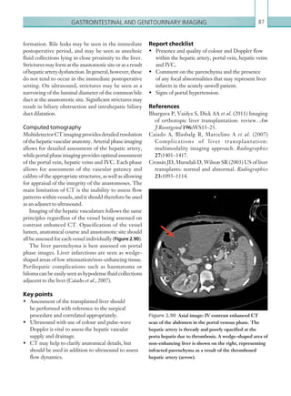 Gastrointestinal and genitourinary imaging 87
Report checklist
•	 Presence and quality of colour and Doppler flow
within the hepatic artery, portal vein, hepatic veins
and IVC.
•	 Comment on the parenchyma and the presence
of any focal abnormalities that may represent liver
infarcts in the acutely unwell patient.
•	 Signs of portal hypertension.
References
Bhargava P, Vaidya S, Dick AA et al. (2011) Imaging
of orthotopic liver transplantation: review. Am
J Roentgenol 196:WS15–25.
Caiado A, Blasbalg R, Marcelino A et al. (2007)
Complications of liver transplantation:
multimodality imaging approach. Radiographics
27:1401–1417.
Crossin JD, Muradali D, Wilson SR (2003) US of liver
transplants: normal and abnormal. Radiographics
23:1093–1114.
formation. Bile leaks may be seen in the immediate
postoperative period, and may be seen as anechoic
fluid collections lying in close proximity to the liver.
Stricturesmayformattheanastomoticsiteorasaresult
ofhepaticarterydysfunction.Ingeneral,however,these
do not tend to occur in the immediate postoperative
setting. On ultrasound, strictures may be seen as a
narrowing of the luminal diameter of the common bile
duct at the anastomotic site. Significant strictures may
result in biliary obstruction and intrahepatic biliary
duct dilatation.
Computed tomography
MultidetectorCTimagingprovidesdetailedresolution
of the hepatic vascular anatomy. Arterial phase imaging
allows for detailed assessment of the hepatic artery,
whileportalphaseimagingprovidesoptimalassessment
of the portal vein, hepatic veins and IVC. Each phase
allows for assessment of the vascular patency and
calibre of the appropriate structures, as well as allowing
for appraisal of the integrity of the anastomoses. The
main limitation of CT is the inability to assess flow
patterns within vessels, and it should therefore be used
as an adjunct to ultrasound.
Imaging of the hepatic vasculature follows the same
principles regardless of the vessel being assessed on
contrast enhanced CT. Opacification of the vessel
lumen, anatomical course and anastomotic site should
all be assessed for each vessel individually (Figure 2.90).
The liver parenchyma is best assessed on portal
phase images. Liver infarctions are seen as wedge-
shaped areas of low attenuation/non-enhancing tissue.
Perihepatic complications such as haematoma or
biloma can be easily seen as hypodense fluid collections
adjacent to the liver (Caiado et al., 2007).
Key points
•	 Assessment of the transplanted liver should
be performed with reference to the surgical
procedure and correlated appropriately.
•	 Ultrasound with use of colour and pulse-wave
Doppler is vital to assess the hepatic vascular
supply and drainage.
•	 CT may help to clarify anatomical details, but
should be used in addition to ultrasound to assess
flow dynamics.
Figure 2.90  Axial image: IV contrast enhanced CT
scan of the abdomen in the portal venous phase. The
hepatic artery is thready and poorly opacified at the
porta hepatis due to thrombosis. A wedge-shaped area of
non-enhancing liver is shown on the right, ­representing
infracted parenchyma as a result of the thrombosed
hepatic artery (arrow).
K22247_C002.indd 87 16/05/15 3:07 AM
 