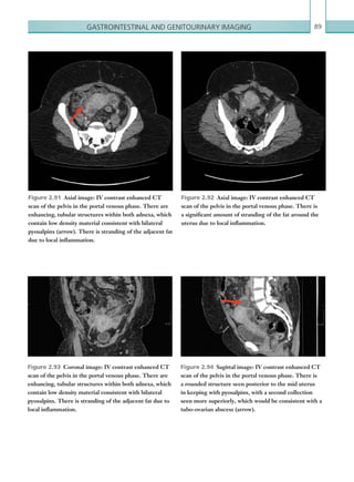 Gastrointestinal and genitourinary imaging 89
Figure 2.91  Axial image: IV contrast enhanced CT
scan of the pelvis in the portal venous phase. There are
enhancing, tubular structures within both adnexa, which
contain low density material consistent with bilateral
pyosalpinx (arrow). There is stranding of the adjacent fat
due to local inflammation.
Figure 2.92  Axial image: IV contrast enhanced CT
scan of the pelvis in the portal venous phase. There is
a significant amount of stranding of the fat around the
uterus due to local inflammation.
Figure 2.93  Coronal image: IV contrast enhanced CT
scan of the pelvis in the portal venous phase. There are
enhancing, tubular structures within both adnexa, which
contain low density material consistent with bilateral
pyosalpinx. There is stranding of the adjacent fat due to
local inflammation.
Figure 2.94  Sagittal image: IV contrast enhanced CT
scan of the pelvis in the portal venous phase. There is
a rounded structure seen posterior to the mid uterus
in keeping with pyosalpinx, with a second collection
seen more superiorly, which would be consistent with a
­tubo-ovarian abscess (arrow).
K22247_C002.indd 89 16/05/15 3:07 AM
 