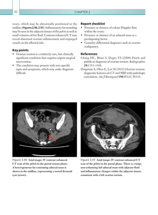 Chapter 292
ovary, which may be abnormally positioned in the
midline(Figures2.96,2.97).Inflammatoryfatstranding
maybeseenintheadjacenttissuesofthepelvisaswellas
small volumes of free fluid. Contrast enhanced CT may
reveal abnormal ovarian enhancement and engorged
vessels on the affected side.
Key points
•	 Ovarian torsion is a relatively rare, but clinically
significant condition that requires urgent surgical
intervention.
•	 The condition may present with non-specific
signs and symptoms, which may make diagnosis
difficult.
Figure 2.96  Axial image: IV contrast enhanced
CT scan of the pelvis in the portal venous phase.
A ­heterogeneous fat-containing adnexal mass is
shown in the midline, representing a torted dermoid
cyst (arrow).
Figure 2.97  Axial image: IV contrast enhanced CT
scan of the pelvis in the portal phase. There is a large,
non-enhancing left adnexal mass with adjacent fluid
and inflammatory changes within the adjacent tissues
consistent with a left ovarian torsion.
Report checklist
•	 Presence or absence of colour Doppler flow
within the ovary.
•	 Presence or absence of an adnexal mass as a
predisposing factor.
•	 Consider differential diagnoses such as ovarian
malignancy.
References
Chang HC, Bhatt S, Dogra VS (2008) Pearls and
pitfalls in diagnosis of ovarian torsion. Radiographics
28:1355–1368.
Duigenan S, Oliva E, Lee SI (2012) Ovarian torsion:
diagnostic features on CT and MRI with pathologic
correlation. Am J Roentgenol 198:W122–W131.
K22247_C002.indd 92 16/05/15 3:07 AM
 