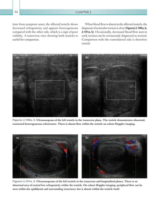 Chapter 294
time from symptom onset, the affected testicle shows
decreased echogenicity and appears heterogeneous
compared with the other side, which is a sign of poor
viability. A transverse view showing both testicles is
useful for comparison.
Figures 2.101a, b  Ultrasonograms of the left testicle in the transverse and longitudinal planes. There is an
­abnormal area of central low echogenicity within the testicle. On colour Doppler imaging, peripheral flow can be
seen within the epididymis and surrounding structures, but is absent within the testicle itself.
Figures 2.100a, b  Ultrasonogram of the left testicle in the transverse plane. The testicle demonstrates abnormal,
coarsened heterogeneous echotexture. There is absent flow within the testicle on colour Doppler imaging.
Whenbloodflowisabsentintheaffectedtesticle,the
diagnosisoftesticulartorsionisclear(Figures 2.100a, b,
2.101a, b). Occasionally, decreased blood flow seen in
early torsion can be erroneously diagnosed as normal.
Comparison with the contralateral side is therefore
crucial.
(a) (b)
(a) (b)
K22247_C002.indd 94 16/05/15 3:07 AM
 