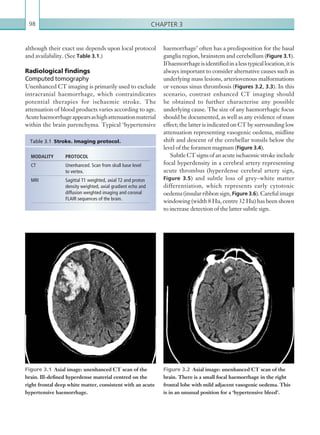 Chapter 398
although their exact use depends upon local protocol
and availability. (See Table 3.1.)
Radiological findings
Computed tomography
Unenhanced CT imaging is primarily used to exclude
intracranial haemorrhage, which contraindicates
potential therapies for ischaemic stroke. The
attenuation of blood products varies according to age.
Acutehaemorrhageappearsashighattenuationmaterial
within the brain parenchyma. Typical ‘hypertensive
haemorrhage’ often has a predisposition for the basal
ganglia region, brainstem and cerebellum (Figure 3.1).
Ifhaemorrhageisidentifiedinalesstypicallocation,itis
always important to consider alternative causes such as
underlying mass lesions, arteriovenous malformations
or venous sinus thrombosis (Figures 3.2, 3.3). In this
scenario, contrast enhanced CT imaging should
be obtained to further characterise any possible
underlying cause. The size of any haemorrhagic focus
should be documented, as well as any evidence of mass
effect; the latter is indicated on CT by surrounding low
attenuation representing vasogenic oedema, midline
shift and descent of the cerebellar tonsils below the
level of the foramen magnum (Figure 3.4).
Subtle CT signs of an acute ischaemic stroke include
focal hyperdensity in a cerebral artery representing
acute thrombus (hyperdense cerebral artery sign,
Figure 3.5) and subtle loss of grey–white matter
differentiation, which represents early cytotoxic
oedema (insular ribbon sign, Figure 3.6). Careful image
windowing (width 8 Hu, centre 32 Hu) has been shown
to increase detection of the latter subtle sign.
MODALITY PROTOCOL
CT Unenhanced. Scan from skull base level
to vertex.
MRI Sagittal T1 weighted, axial T2 and proton
­density weighted, axial gradient echo and
diffusion weighted imaging and coronal
FLAIR sequences of the brain.
Table 3.1  Stroke. Imaging protocol.
Figure 3.2  Axial image: unenhanced CT scan of the
brain. There is a small focal haemorrhage in the right
frontal lobe with mild adjacent vasogenic oedema. This
is in an unusual position for a ‘hypertensive bleed’.
Figure 3.1  Axial image: unenhanced CT scan of the
brain. Ill-defined hyperdense material centred on the
right frontal deep white matter, consistent with an acute
hypertensive haemorrhage.
K22247_C003.indd 98 16/05/15 3:08 AM
 