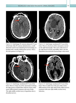 Neurology and non-traumatic spinal imaging 99
Figure 3.4  Axial image: unenhanced CT scan of the
brain. There is a focal area of low attenuation centred
on the right basal ganglia. This causes effacement of
the right lateral ventricle and midline shift to the left.
Dependent intraventricular haemorrhage is also noted.
Figure 3.5  Axial image: unenhanced CT scan of the
brain. There is a large area of low attenuation involving
the right parieto-occipital lobes with loss of grey-white
matter differentiation consistent with acute stroke.
The right middle cerebral artery is hyperdense due to
thrombus (arrow).
Figure 3.3  Axial image: IV contrast enhanced CT scan
of the brain. After IV contrast administration, a small
abnormal vessel is seen underlying the haemorrhage, in
keeping with a vascular malformation (arrow). This is
the same patient as in Figure 3.2.
Figure 3.6  Axial image: unenhanced CT scan of the
brain. There is subtle loss of the grey-white matter
­differentiation of the right-sided insular ribbon (arrow),
consistent with acute right middle cerebral artery
infarction.
K22247_C003.indd 99 16/05/15 3:08 AM
 