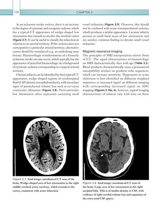 Chapter 3100
vessel ischaemia (Figure 3.9). However, this should
not be confused with acute transependymal oedema,
which produces a similar appearance. Lacunar infarcts
present as small focal areas of low attenuation and
are another common finding in chronic small vessel
ischaemia.
Magnetic resonance imaging
The principles of MRI interpretation mirror those
of CT. The signal characteristics of haemorrhage
on MRI characteristically alter with age (Table 3.2).
Blood products characteristically cause a pronounced
susceptibility artefact on gradient echo sequences,
which can increase sensitivity. Hyperacute to acute
infarction is best identified on diffusion weighted
sequences as increased signal on diffusion imaging
with corresponding decreased signal on ADC
mapping (Figures 3.10a, b); however, typical imaging
characteristics of infarcts vary with time on these
As an ischaemic stroke evolves, there is an increase
in the degree of cytotoxic and vasogenic oedema, which
has a typical CT appearance of wedge-shaped low
attenuation that extends to involve the cerebral cortex
(Figure 3.7). It can be useful to classify the infarction in
relation to its arterial territory. If the oedema does not
correspond to a particular arterial territory, alternative
causes should be considered (e.g. an underlying mass
lesion). Haemorrhagic transformation of a formerly
ischaemic stroke can also occur, which typically has the
appearance of petechial haemorrhage on a background
of cytotoxic oedema corresponding to a typical arterial
territory.
ChronicinfarctscanbeidentifiedbytheirtypicalCT
appearance; wedge-shaped regions of cerebrospinal
fluid(CSF)density(encephalomalacia),withsecondary
signs of parenchymal volume loss such as ex-vacuo
ventricular dilatation (Figure 3.8). Periventricular
low attenuation often represents coexisting small
Figure 3.7  Axial image: unenhanced CT scan of the
brain. Wedge-shaped area of low attenuation in the right
middle cerebral artery territory, which extends to the
cortex, consistent with acute infarction.
Figure 3.8  Axial image: unenhanced CT scan of
the brain. Large area of low attenuation in the right
occipital lobe. This is of similar density to CSF, with
evidence of right cerebal volume loss and expansion of
the extra-axial CSF spaces.
K22247_C003.indd 100 16/05/15 3:08 AM
 
