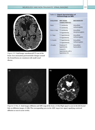 Neurology and non-traumatic spinal imaging 101
Figures 3.10a, b  Axial images: diffusion and ADC map of the brain. (3.10a) High signal is seen in the left frontal
lobe on diffusion images. (3.10b) The corresponding area on the ADC map is low signal, signifying restricted
­diffusion as seen in acute stroke.
Figure 3.9  Axial image: unenhanced CT scan of the
brain. Low attenuation periventricular changes around
the frontal horns are consistent with small vessel
disease.
Table 3.2 Signal characteristics of
haemorrhage on MRI.
EVOLUTION MRI SIGNAL
­CHARACTERISTICS
BIOCHEMISTRY
Hours T1 isointensity
T2 isointensity
Intracellular
­oxyhaemaglobin
Hours–2 days T1 isointensity
T2 hypointensity
Intracellular
­deoxyhaemaglobin
2–7 days T1 hyperintensity
T2 hypointensity
Intracellular
­methaemaglobin
1–4 weeks T1 hyperintensity
T2 hyperintensity
Extracellular
­methaemaglobin
4 weeks Peripheral T1
­hypointensity
Central T2
­hyperintensity with a
hypointense rim
Extracellular
­haemosiderin
(a) (b)
K22247_C003.indd 101 16/05/15 3:08 AM
 