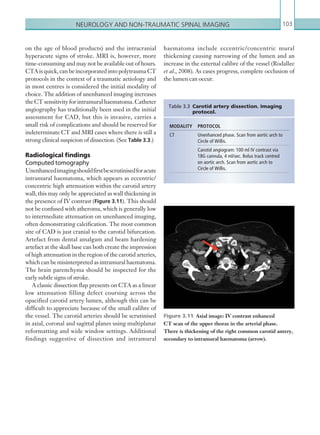 Neurology and non-traumatic spinal imaging 103
haematoma include eccentric/concentric mural
thickening causing narrowing of the lumen and an
increase in the external calibre of the vessel (Rodallec
et al., 2008). As cases progress, complete occlusion of
the lumen can occur.
on the age of blood products) and the intracranial
hyperacute signs of stroke. MRI is, however, more
time-consuming and may not be available out of hours.
CTA is quick, can be incorporated into polytrauma CT
protocols in the context of a traumatic aetiology and
in most centres is considered the initial modality of
choice. The addition of unenhanced imaging increases
the CT sensitivity for intramural haematoma. Catheter
angiography has traditionally been used in the initial
assessment for CAD, but this is invasive, carries a
small risk of complications and should be reserved for
indeterminate CT and MRI cases where there is still a
strong clinical suspicion of dissection. (See Table 3.3.)
Radiological findings
Computed tomography
Unenhancedimagingshouldfirstbescrutinisedforacute
intramural haematoma, which appears as eccentric/
concentric high attenuation within the carotid artery
wall; this may only be appreciated as wall thickening in
the presence of IV contrast (Figure 3.11). This should
not be confused with atheroma, which is generally low
to intermediate attenuation on unenhanced imaging,
often demonstrating calcification. The most common
site of CAD is just cranial to the carotid bifurcation.
Artefact from dental amalgam and beam hardening
artefact at the skull base can both create the impression
of high attenuation in the region of the carotid arteries,
which can be misinterpreted as intramural haematoma.
The brain parenchyma should be inspected for the
early subtle signs of stroke.
A classic dissection flap presents on CTA as a linear
low attenuation filling defect coursing across the
opacified carotid artery lumen, although this can be
difficult to appreciate because of the small calibre of
the vessel. The carotid arteries should be scrutinised
in axial, coronal and sagittal planes using multiplanar
reformatting and wide window settings. Additional
findings suggestive of dissection and intramural
MODALITY PROTOCOL
CT Unenhanced phase. Scan from aortic arch to
Circle of Willis.
Carotid angiogram: 100 ml IV contrast via
18G cannula, 4 ml/sec. Bolus track centred
on aortic arch. Scan from aortic arch to
Circle of Willis.
Table 3.3 Carotid artery dissection. Imaging
protocol.
Figure 3.11  Axial image: IV contrast enhanced
CT scan of the upper thorax in the arterial phase.
There is thickening of the right common carotid antery,
secondary to intramural haematoma (arrow).
K22247_C003.indd 103 16/05/15 3:08 AM
 