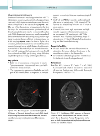 Chapter 3104
Magnetic resonance imaging
Intramural haematoma may be appreciated on axial T1
fat saturated sequences, characteristically appearing as
crescenterichighsignalsurroundingacentralflowvoid,
which corresponds to the carotid artery (Figure 3.12).
The age of the haematoma is important; in the first
few days, the haematoma consists predominantly of
deoxyhaemaglobin and may be isointense (Rodallec
et al.,2008).Intramuralhaematomausuallycausesfocal
dilation of the vessel with corresponding narrowing/
signal loss in the lumen, which is best appreciated on
MRA imaging (Figure 3.13). On time of flight MRA
sequences,intramuralhaematomacanmanifestasarim
aroundthecarotidartery,whichdisplayssignalintensity
between that of the arterial flow and periarterial tissues.
As with CT imaging, the brain parenchyma should
be scrutinised on MRI, particularly using diffusion
weighted sequences, looking for the signs of stroke.
Key points
•	 CAD can be spontaneous or traumatic in nature.
Spontaneous cases are commonly associated with
connective tissue disorders.
•	 The commonest symptoms are headache and neck
pain. CAD should always be suspected in younger
patients presenting with acute-onset neurological
signs.
•	 Both CT and MRI are sensitive and specific and
play a role in investigating CAD, although CT is
quicker and more readily available out of hours at
most centres.
•	 Eccentric/concentric high attenuation and high
signal is suggestive of intramural haematoma
on unenhanced CT imaging and axial T1 fat
saturated MRI sequences, respectively. Signs of
dissection on CTA and MRA include a dissection
flap and focal luminal narrowing.
Report checklist
•	 In cases positive for intramural haematoma or
dissection, document whether flow is seen in the
carotid artery distal to the abnormality.
•	 Recommend further imaging of the brain to look
for ischaemia if not already performed.
Reference
Rodallec MH, Marteau V, Gerber S et al. (2008)
Craniocervical arterial dissection: spectrum
of imaging findings and differential diagnosis.
Radiographics 28:1711–1728.
Figure 3.12  Axial image: T1 fat saturated weighted
MR image of the neck. A rim of crescenteric high signal
is seen along the anteromedial wall of the left internal
carotid artery, representing intramural haematoma
(arrow).
Figure 3.13  Axial image: MRA sequence of the neck.
There is absent flow within the left internal carotid
artery due to dissection. Normal flow patterns can be
seen in the left external carotid, right internal/external
carotid and vertebral arteries.
K22247_C003.indd 104 16/05/15 3:08 AM
 