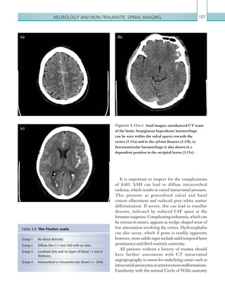 Neurology and non-traumatic spinal imaging 107
Figures 3.15a–c  Axial images: unenhanced CT scans
of the brain. Serpiginous hyperdense ­haemorrhage
can be seen within the sulcal spaces towards the
vertex (3.15a) and in the sylvian fissures (3.15b, c).
­Intraventricular haemorrhage is also shown in a
­dependent position in the occipital horns (3.15c).
(a) (b)
(c)
It is important to inspect for the complications
of SAH. SAH can lead to diffuse intracerebral
oedema, which results in raised intracranial pressure.
This presents as generalised sulcal and basal
cistern effacement and reduced grey–white matter
differentiation. If severe, this can lead to tonsillar
descent, indicated by reduced CSF space at the
foramen magnum. Complicating ischaemia, which can
be venous in nature, appears as wedge-shaped areas of
low attenuation involving the cortex. Hydrocephalus
can also occur, which if gross is readily apparent;
however, more subtle signs include mild temporal horn
prominence and third ventricle convexity.
All patients without a history of trauma should
have further assessment with CT intracranial
angiogrography to assess for underlying causes such as
intracranialaneurysmsorarteriovenousmalformations.
Familiarity with the normal Circle of Willis anatomy
Group 1 No blood detected.
Group 2 Diffuse thin (1 mm) SAH with no clots.
Group 3 Localised clots and /or layers of blood 1 mm in
thickness.
Group 4 Intracerebral or intraventricular blood (+/− SAH).
Table 3.8 The Fischer scale.
K22247_C003.indd 107 16/05/15 3:08 AM
 