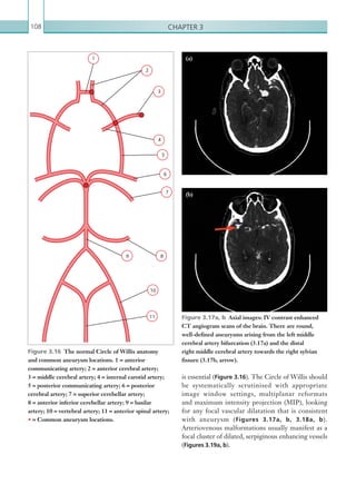 Chapter 3108
is essential (Figure 3.16). The Circle of Willis should
be systematically scrutinised with appropriate
image window settings, multiplanar reformats
and maximum intensity projection (MIP), looking
for any focal vascular dilatation that is consistent
with aneurysm (Figures 3.17a, b, 3.18a, b).
Arteriovenous malformations usually manifest as a
focal cluster of dilated, serpiginous enhancing vessels
(Figures 3.19a, b).
Figure 3.17a, b  Axial images: IV contrast enhanced
CT angiogram scans of the brain. There are round,
well-defined aneurysms arising from the left middle
cerebral artery bifurcation (3.17a) and the distal
right middle cerebral artery towards the right sylvian
fissure (3.17b, arrow).
(a)
(b)
Figure 3.16  The normal Circle of Willis anatomy
and common aneurysm locations. 1 = anterior
communicating artery; 2 = anterior cerebral artery;
3 = middle cerebral artery; 4 = internal carotid artery;
5 = posterior communicating artery; 6 = posterior
cerebral artery; 7 = superior cerebellar artery;
8 = anterior inferior cerebellar artery; 9 = basilar
artery; 10 = vertebral artery; 11 = anterior spinal artery;
• = Common aneurysm locations.
1
2
3
4
5
6
7
89
10
11
K22247_C003.indd 108 16/05/15 3:08 AM
 