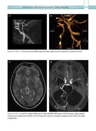 Neurology and non-traumatic spinal imaging 109
Figures 3.18a, b  3-D reconstructed MIP images showing a right internal carotid artery aneurysm (arrow).
Figures 3.19a, b  Axial T2 weighted MR image (3.19a) and MRA MIP image (3.19b) showing a right occipital
arteriovenous malformation. On the axial T2 image this is shown as multiple, serpiginous flow voids in the right
occipital lobe.
(a)
(a) (b)(b)
(b)(b)
s
A R
I
L P
Post/Rt
Sup/Ant
Ant/Lft
Inf/Post
K22247_C003.indd 109 16/05/15 3:08 AM
 