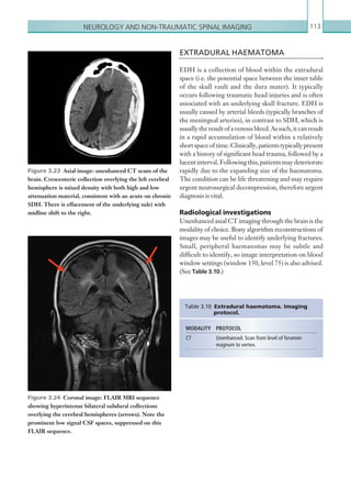 Neurology and non-traumatic spinal imaging 113
EXTRADURAL HAEMATOMA
EDH is a collection of blood within the extradural
space (i.e. the potential space between the inner table
of the skull vault and the dura mater). It typically
occurs following traumatic head injuries and is often
associated with an underlying skull fracture. EDH is
usually caused by arterial bleeds (typically branches of
the meningeal arteries), in contrast to SDH, which is
usuallytheresultofavenousbleed.Assuch,itcanresult
in a rapid accumulation of blood within a relatively
shortspaceoftime.Clinically,patientstypicallypresent
with a history of significant head trauma, followed by a
lucentinterval.Followingthis,patientsmaydeteriorate
rapidly due to the expanding size of the haematoma.
The condition can be life threatening and may require
urgent neurosurgical decompression, therefore urgent
diagnosis is vital.
Radiological investigations
Unenhanced axial CT imaging through the brain is the
modality of choice. Bony algorithm reconstructions of
images may be useful to identify underlying fractures.
Small, peripheral haematomas may be subtle and
difficult to identify, so image interpretation on blood
window settings (window 150, level 75) is also advised.
(See Table 3.10.)
Figure 3.23  Axial image: unenhanced CT scans of the
brain. Crescenteric collection overlying the left cerebral
hemisphere is mixed density with both high and low
attenuation material, consistent with an acute on chronic
SDH. There is effacement of the underlying sulci with
midline shift to the right.
Figure 3.24  Coronal image: FLAIR MRI sequence
showing hyperintense bilateral subdural collections
overlying the cerebral hemispheres (arrows). Note the
prominent low signal CSF spaces, suppressed on this
FLAIR sequence.
MODALITY PROTOCOL
CT Unenhanced. Scan from level of foramen
magnum to vertex.
Table 3.10 Extradural haematoma. Imaging
protocol.
K22247_C003.indd 113 16/05/15 3:08 AM
 
