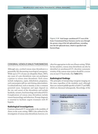 Neurology and non-traumatic spinal imaging 115
often less appropriate in the out of hours setting. While
far less sensitive, venous sinus thrombosis can also be
identified on unenhanced CT, therefore systematic
scrutiny of the venous sinus system should be a review
area on any CT head study. (See Table 3.11.)
Radiological findings
The principles of interpreting venogram imaging are
the same regardless of the modality used, although
therearecommonpitfallsspecifictobothCTandMRI,
which are discussed subsequently. Knowledge of the
CEREBRAL VENOUS SINUS THROMBOSIS
Although rare, cerebral venous sinus thrombosis is a
potentially life-threatening neurological emergency.
While up to 25% of cases are idiopathic (Stam, 2003),
any cause of a pro-thrombotic state can predispose
a patient to venous sinus thrombosis. Such causes
include malignancy, sepsis, dehydration, pregnancy,
oral contraceptive pill use and clotting abnormalities.
Localised infection, such as sinusitis, is also a common
potential cause. Symptoms and signs depend on
the site and extent of the thrombosis and include
headache, seizures, focal neurology and reduced GCS.
Complications of venous sinus thrombosis include
venous haemorrhage and infarction. Prompt diagnosis
is essential to facilitate urgent treatment with IV
heparin.
Radiological investigations
Contrast enhanced CT venography is the modality of
choice in the acute setting. MRI is also utilised in the
investigation of venous sinus thrombosis; however, it is
Figure 3.26  Axial image: unenhanced CT scan of the
brain. Comminuted linear fractures can be seen through
the greater wing of the left sphenoid bone, extending
into the left sphenoid sinus, which is opacified with
haemorrhage.
MODALITY PROTOCOL
CT Intracranial venogram: 100 ml IV contrast via
18G cannula, 2 ml/sec. Scan at 45 seconds
after initiation of injection. Scan from skull
base to vertex level.
Table 3.11 Cerebral venous sinus thrombosis.
Imaging protocol.
K22247_C003.indd 115 16/05/15 3:08 AM
 