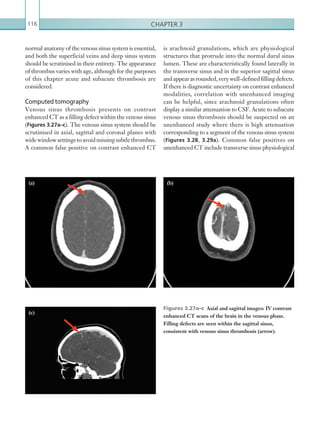 Chapter 3116
is arachnoid granulations, which are physiological
structures that protrude into the normal dural sinus
lumen. These are characteristically found laterally in
the transverse sinus and in the superior sagittal sinus
andappearasrounded,verywell-definedfillingdefects.
If there is diagnostic uncertainty on contrast enhanced
modalities, correlation with unenhanced imaging
can be helpful, since arachnoid granulations often
display a similar attenuation to CSF. Acute to subacute
venous sinus thrombosis should be suspected on an
unenhanced study where there is high attenuation
corresponding to a segment of the venous sinus system
(Figures 3.28, 3.29a). Common false positives on
unenhanced CT include transverse sinus physiological
normal anatomy of the venous sinus system is essential,
and both the superficial veins and deep sinus system
should be scrutinised in their entirety. The appearance
of thrombus varies with age, although for the purposes
of this chapter acute and subacute thrombosis are
considered.
Computed tomography
Venous sinus thrombosis presents on contrast
enhanced CT as a filling defect within the venous sinus
(Figures 3.27a–c). The venous sinus system should be
scrutinised in axial, sagittal and coronal planes with
widewindowsettingstoavoidmissingsubtlethrombus.
A common false positive on contrast enhanced CT
(a) (b)
(c)
Figures 3.27a–c  Axial and sagittal images: IV contrast
enhanced CT scans of the brain in the venous phase.
Filling defects are seen within the sagittal sinus,
consistent with venous sinus thrombosis (arrow).
K22247_C003.indd 116 16/05/15 3:08 AM
 