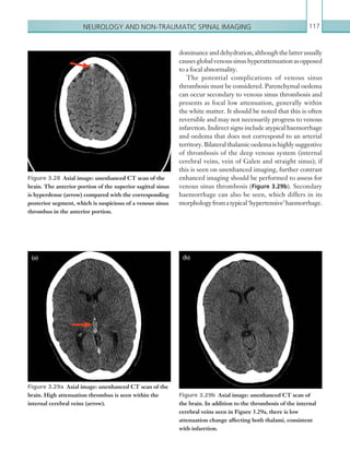 Neurology and non-traumatic spinal imaging 117
dominanceanddehydration,althoughthelatterusually
causesglobalvenoussinushyperattenuationasopposed
to a focal abnormality.
The potential complications of venous sinus
thrombosis must be considered. Parenchymal oedema
can occur secondary to venous sinus thrombosis and
presents as focal low attenuation, generally within
the white matter. It should be noted that this is often
reversible and may not necessarily progress to venous
infarction. Indirect signs include atypical haemorrhage
and oedema that does not correspond to an arterial
territory.Bilateralthalamicoedemaishighlysuggestive
of thrombosis of the deep venous system (internal
cerebral veins, vein of Galen and straight sinus); if
this is seen on unenhanced imaging, further contrast
enhanced imaging should be performed to assess for
venous sinus thrombosis (Figure 3.29b). Secondary
haemorrhage can also be seen, which differs in its
morphologyfromatypical‘hypertensive’ haemorrhage.
Figure 3.28  Axial image: unenhanced CT scan of the
brain. The anterior portion of the superior sagittal sinus
is hyperdense (arrow) compared with the corresponding
posterior segment, which is suspicious of a venous sinus
thrombus in the anterior portion.
Figure 3.29a  Axial image: unenhanced CT scan of the
brain. High attenuation thrombus is seen within the
internal cerebral veins (arrow).
Figure 3.29b  Axial image: unenhanced CT scan of
the brain. In addition to the thrombosis of the internal
cerebral veins seen in Figure 3.29a, there is low
attenuation change affecting both thalami, consistent
with infarction.
(a) (b)
K22247_C003.indd 117 16/05/15 3:08 AM
 