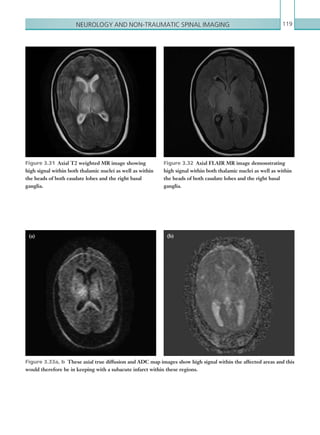 Neurology and non-traumatic spinal imaging 119
Figure 3.33a, b  These axial true diffusion and ADC map images show high signal within the affected areas and this
would therefore be in keeping with a subacute infarct within these regions.
Figure 3.31  Axial T2 weighted MR image showing
high signal within both thalamic nuclei as well as within
the heads of both caudate lobes and the right basal
ganglia.
Figure 3.32  Axial FLAIR MR image demonstrating
high signal within both thalamic nuclei as well as within
the heads of both caudate lobes and the right basal
ganglia.
(a) (b)
K22247_C003.indd 119 16/05/15 3:08 AM
 