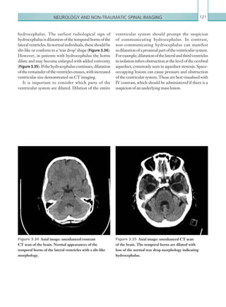 Neurology and non-traumatic spinal imaging 121
ventricular system should prompt the suspicion
of communicating hydrocephalus. In contrast,
non-communicating hydrocephalus can manifest
as dilatationofaproximalpartoftheventricularsystem.
Forexample,dilatationofthelateralandthirdventricles
inisolationinfersobstructionatthelevelofthecerebral
aqueduct, commonly seen in aqueduct stenosis. Space-
occupying lesions can cause pressure and obstruction
of the ventricular system. These are best visualised with
IV contrast, which should be administered if there is a
suspicion of an underlying mass lesion.
hydrocephalus. The earliest radiological sign of
hydrocephalus is dilatation of the temporal horns of the
lateralventricles.Innormalindividuals,theseshouldbe
slit-like or conform to a ‘tear drop’ shape (Figure 3.34).
However, in patients with hydrocephalus the horns
dilate and may become enlarged with added convexity
(Figure 3.35).Ifthehydrocephaluscontinues,dilatation
oftheremainderoftheventriclesensues,withincreased
ventricular size demonstrated on CT imaging.
It is important to consider which parts of the
ventricular system are dilated. Dilation of the entire
Figure 3.34  Axial image: unenhanced contrast
CT scan of the brain. Normal appearances of the
temporal horns of the lateral ventricles with a slit-like
morphology.
Figure 3.35  Axial image: unenhanced CT scan
of the brain. The temporal horns are dilated with
loss of the normal tear drop morphology indicating
hydrocephalus.
K22247_C003.indd 121 16/05/15 3:08 AM
 