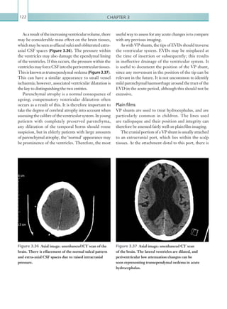 Chapter 3122
Asaresultoftheincreasingventricularvolume,there
may be considerable mass effect on the brain tissues,
whichmaybeseenaseffacedsulciandobliteratedextra-
axial CSF spaces (Figure 3.36). The pressure within
the ventricles may also damage the ependymal lining
of the ventricles. If this occurs, the pressure within the
ventriclesmayforceCSFintotheperiventricular tissues.
Thisisknownastransependymaloedema(Figure 3.37).
This can have a similar appearance to small vessel
ischaemia; however, associated ventricular dilatation is
the key to distinguishing the two entities.
Parenchymal atrophy is a normal consequence of
ageing; compensatory ventricular dilatation often
occurs as a result of this. It is therefore important to
take the degree of cerebral atrophy into account when
assessing the calibre of the ventricular system. In young
patients with completely preserved parenchyma,
any dilatation of the temporal horns should rouse
suspicion, but in elderly patients with large amounts
of parenchymal atrophy, the ‘normal’ appearance may
be prominence of the ventricles. Therefore, the most
useful way to assess for any acute changes is to compare
with any previous imaging.
As with VP shunts, the tips of EVDs should traverse
the ventricular system. EVDs may be misplaced at
the time of insertion or subsequently; this results
in ineffective drainage of the ventricular system. It
is useful to document the position of the VP shunt,
since any movement in the position of the tip can be
relevant in the future. It is not uncommon to identify
mild parenchymal haemorrhage around the tract of the
EVD in the acute period, although this should not be
excessive.
Plain films
VP shunts are used to treat hydrocephalus, and are
particularly common in children. The lines used
are radiopaque and their position and integrity can
therefore be assessed fairly well on plain film imaging.
The cranial portion of a VP shunt is usually attached
to an extracranial port, which lies within the scalp
tissues. At the attachment distal to this port, there is
Figure 3.37  Axial image: unenhanced CT scan
of the brain. The lateral ventricles are dilated, and
periventricular low attenuation changes can be
seen representing transependymal oedema in acute
hydrocephalus.
Figure 3.36  Axial image: unenhanced CT scan of the
brain. There is effacement of the normal sulcal pattern
and extra-axial CSF spaces due to raised intracranial
pressure.
K22247_C003.indd 122 16/05/15 3:08 AM
 