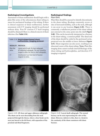 Chapter 3124
Radiological investigations
Assessment of shunt malfunction should begin with a
plain film series of the subcutaneous shunt tubing to
assess for mechanical breakage of the tubing. If there
is clinical suspicion of shunt malfunction, further
assessment with CT imaging should be performed
without delay. Post IV contrast CT head imaging
should be obtained if there is a clinical concern of shunt
infection. (See Table 3.14.)
Radiological findings
Plain films
Plain films should be assessed to identify discontinuity
in the shunt tubing. Breakage commonly occurs at
sites of increased mobility, such as the neck, although
it can occur in any location (Figure 3.39). There is
commonly a radiolucent portion of the shunt tubing
just external to the entry point into the skull (Figure
3.40). This can be incorrectly interpreted as a fracture
in the shunt tubing, a common pitfall. The distal end
of the shunt should be coiled in the peritoneal cavity,
projected over the middle to lower abdomen (Figure
3.41). Shunt migration can also occur, resulting in an
abnormal course of the shunt tubing. Note: Plain film
imaging alone cannot exclude internal blockage of the
shunt tubing and hydrocephalus, and therefore CT
imaging is required.
MODALITY PROTOCOL
Plain film
series
Lateral and AP skull. PA chest radiograph.
AP abdominal radiograph. The neck should be
imaged in either the chest or skull radiographs.
CT Unenhanced. Scan from level of foramen
magnum to vertex.
Table 3.14 Ventriculoperitoneal shunt
malfunctions. Imaging protocol.
Figure 3.39  AP chest and upper abdomen radiograph.
The shunt can be seen descending from the neck
projected through the thorax, where a clear break can be
seen just lateral to the left heart, with separation of the
proximal and distal fragments.
Figure 3.40  Lateral skull radiograph. The normal
lucency can be seen representing the valve of the
shunt. However, inferior to this, there is a break in
the continuity of the shunt consistent with shunt
fracture.
K22247_C003.indd 124 16/05/15 3:08 AM
 