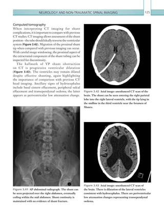 Neurology and non-traumatic spinal imaging 125
Computed tomography
When interpreting CT imaging for shunt
complications, it is important to compare with previous
CT studies. CT imaging allows assessment of the shunt
position–thetubeshouldideallytraversetheventricular
system (Figure 3.42). Migration of the proximal shunt
tip when compared with previous imaging can occur.
With careful image windowing, the proximal aspect of
the extracranial component of the shunt tubing can be
inspected for discontinuity.
The hallmark of VP shunt obstruction
on CT is progressive ventricular dilatation
(Figure 3.43). The ventricles may remain dilated
despite effective shunting, again highlighting
the importance of comparison with previous CT
head imaging. Ancillary signs of hydrocephalus
include basal cistern effacement, peripheral sulcal
effacement and transependymal oedema; the latter
appears as periventricular low attenuation change.
Figure 3.41  AP abdominal radiograph. The shunt can
be seen projected over the right abdomen, eventually
coiling within the mid abdomen. Shunt continuity is
maintained with no evidence of shunt fracture.
Figure 3.42  Axial image: unenhanced CT scan of the
brain. The shunt can be seen entering the right parietal
lobe into the right lateral ventricle, with the tip lying in
the midline in the third ventricle near the foramen of
Munro.
Figure 3.43  Axial image: unenhanced CT scan of
the brain. There is dilatation of the lateral ventricles
consistent with hydrocephalus. There are periventricular
low attenuation changes representing transependymal
oedema.
K22247_C003.indd 125 16/05/15 3:08 AM
 