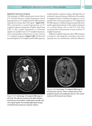 Neurology and non-traumatic spinal imaging 129
Magnetic resonance imaging
The principles of MRI interpretation mirror that of
CT. Cerebral abscesses usually demonstrate central
hyperintensity on T2 weighted and FLAIR sequences
(typically less intense than CSF signal – Figure 3.47).
This corresponds to central hypointensity on T1
weighted sequences (typically of higher signal than
CSF). A thin, regular hypointense to isointense
capsule can usually be seen on T2 weighted sequences,
with corresponding enhancement on post-contrast
T1 weighted sequences (Figure 3.48). Perilesional
increased signal on T2 weighted and FLAIR sequences
usually signifies vasogenic oedema, although this can
sometimes represent tumour infiltration if secondary
to malignant lesions. Cerebritis may appear as a non-
specific focus of increased signal on T2 weighted and
FLAIR sequences. Subdural empyemas generally show
similar signal characteristics to the central component
of a cerebral abscess and, as with CT, may show
associated dural enhancement on post-contrast T1
weighted sequences.
Diffusion weighted sequences allow differentiation
of infective and malignant aetiologies; the latter
typically does not demonstrate restricted diffusion,
Figure 3.47  Axial image: T2 weighted MR image of
the brain. The abscess centred on the right thalamus
demonstrates intermediate to high signal centrally with
a low signal capsule. Surrounding high signal changes
around the lesion represent vasogenic oedema.
Figure 3.48  Axial image: T1 weighted MR image of
the brain post contrast. There is enhancement of the
peripheral capsule surrounding the abscess. The central
contents of the lesion do not enhance.
K22247_C003.indd 129 16/05/15 3:08 AM
 