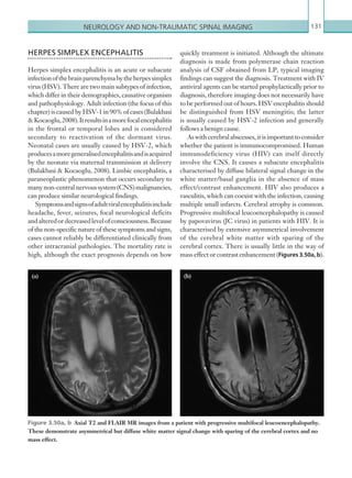 Neurology and non-traumatic spinal imaging 131
quickly treatment is initiated. Although the ultimate
diagnosis is made from polymerase chain reaction
analysis of CSF obtained from LP, typical imaging
findings can suggest the diagnosis. Treatment with IV
antiviral agents can be started prophylactically prior to
diagnosis, therefore imaging does not necessarily have
to be performed out of hours. HSV encephalitis should
be distinguished from HSV meningitis; the latter
is usually caused by HSV-2 infection and generally
follows a benign cause.
Aswithcerebralabscesses,itisimportanttoconsider
whether the patient is immunocompromised. Human
immunodeficiency virus (HIV) can itself directly
involve the CNS. It causes a subacute encephalitis
characterised by diffuse bilateral signal change in the
white matter/basal ganglia in the absence of mass
effect/contrast enhancement. HIV also produces a
vasculitis, which can coexist with the infection, causing
multiple small infarcts. Cerebral atrophy is common.
Progressive multifocal leucoencephalopathy is caused
by papovavirus (JC virus) in patients with HIV. It is
characterised by extensive asymmetrical involvement
of the cerebral white matter with sparing of the
cerebral cortex. There is usually little in the way of
mass effect or contrast enhancement (Figures 3.50a, b).
HERPES SIMPLEX ENCEPHALITIS
Herpes simplex encephalitis is an acute or subacute
infectionofthebrainparenchymabytheherpessimplex
virus (HSV). There are two main subtypes of infection,
which differ in their demographics, causative organism
and pathophysiology. Adult infection (the focus of this
chapter) is caused by HSV-1 in 90% of cases (Bulakbasi
Kocaoglu,2008).Itresultsinamore focalencephalitis
in the frontal or temporal lobes and is considered
secondary to reactivation of the dormant virus.
Neonatal cases are usually caused by HSV-2, which
producesamoregeneralisedencephalitisandisacquired
by the neonate via maternal transmission at delivery
(Bulakbasi  Kocaoglu, 2008). Limbic encephalitis, a
paraneoplastic phenomenon that occurs secondary to
manynon-centralnervoussystem(CNS)malignancies,
can produce similar neurological findings.
Symptomsandsignsofadultviralencephalitisinclude
headache, fever, seizures, focal neurological deficits
and alteredordecreasedlevelofconsciousness.Because
of the non-specific nature of these symptoms and signs,
cases cannot reliably be differentiated clinically from
other intracranial pathologies. The mortality rate is
high, although the exact prognosis depends on how
(a) (b)
Figure 3.50a, b  Axial T2 and FLAIR MR images from a patient with progressive multifocal leucoencephalopathy.
These demonstrate asymmetrical but diffuse white matter signal change with sparing of the cerebral cortex and no
mass effect.
K22247_C003.indd 131 16/05/15 3:08 AM
 