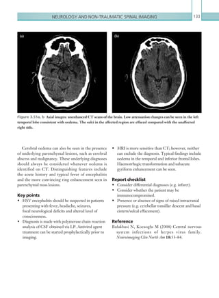Neurology and non-traumatic spinal imaging 133
•	 MRI is more sensitive than CT; however, neither
can exclude the diagnosis. Typical findings include
oedema in the temporal and inferior frontal lobes.
Haemorrhagic transformation and subacute
gyriform enhancement can be seen.
Report checklist
•	 Consider differential diagnoses (e.g. infarct).
•	 Consider whether the patient may be
immunocompromised.
•	 Presence or absence of signs of raised intracranial
pressure (e.g. cerebellar tonsillar descent and basal
cistern/sulcal effacement).
Reference
Bulakbasi N, Kocaoglu M (2008) Central nervous
system infections of herpes virus family.
Neuroimaging Clin North Am 18:53–84.
Cerebral oedema can also be seen in the presence
of underlying parenchymal lesions, such as cerebral
abscess and malignancy. These underlying diagnoses
should always be considered whenever oedema is
identified on CT. Distinguishing features include
the acute history and typical fever of encephalitis
and the more convincing ring enhancement seen in
parenchymal mass lesions.
Key points
•	 HSV encephalitis should be suspected in patients
presenting with fever, headache, seizures,
focal neurological deficits and altered level of
consciousness.
•	 Diagnosis is made with polymerase chain reaction
analysis of CSF obtained via LP. Antiviral agent
treatment can be started prophylactically prior to
imaging.
(a) (b)
Figure 3.51a, b  Axial images: unenhanced CT scans of the brain. Low attenuation changes can be seen in the left
temporal lobe consistent with oedema. The sulci in the affected region are effaced compared with the unaffected
right side.
K22247_C003.indd 133 16/05/15 3:08 AM
 
