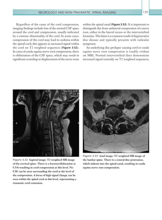 Neurology and non-traumatic spinal imaging 135
within the spinal canal (Figure 3.53). It is important to
distinguish this from unilateral compression of a nerve
root, either in the lateral recess or the intervertebral
foramina.Thelatterisacommonresultofdegenerative
disc disease and typically presents with radicular
symptoms.
An underlying disc prolapse causing cord or cauda
equina nerve root compression is readily evident
on MRI. Normal intervertebral discs demonstrate
increased signal centrally on T2 weighted sequences;
Regardless of the cause of the cord compression,
imaging findings include loss of the normal CSF space
around the cord and compression, usually indicated
by a contour abnormality of the cord. In acute cases,
compression of the cord may lead to oedema within
the spinal cord; this appears as increased signal within
the cord on T2 weighted sequences (Figure 3.52).
In cases of cauda equina nerve root compression, there
is obliteration of the CSF space, which may result in
significant crowding or displacement of the nerve roots
Figure 3.52  Sagittal image: T2 weighted MR image
of the cervical spine. There is a fracture/dislocation at
C5/6 resulting in cord compression at this level. No
CSF can be seen surrounding the cord at the level of
the compression. A focus of high signal change can be
seen within the spinal cord at this level, representing a
traumatic cord contusion.
Figure 3.53  Axial image: T2 weighted MR image of
the lumbar spine. There is a central disc protrusion,
which indents into the spinal canal, resulting in cauda
equina nerve root compression.
K22247_C003.indd 135 16/05/15 3:08 AM
 