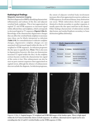 Chapter 3138
the extent of adjacent vertebral body involvement
increases; this is best appreciated as marrow oedema on
STIRsequences.Inadvanceddisease,bonydestruction
can occur. While tuberculosis discitis can appear
identical to discitis secondary to another organism, it
usually spares the disc space until late in the disease.
Other findings characteristic of tuberculosis include
skip lesions and marked kyphosis secondary to bone
destruction (gibbus deformity).
Radiological findings
Magnetic resonance imaging
DiscitisisdiagnosedonMRIbyidentifyingcharacteristic
inflammation and oedema of the disc and adjacent
vertebral body endplates. This is best appreciated on
sagittal T2 and STIR sequences as increased signal
within affected discs and endplates, which corresponds
to decreased signal on T1 sequences (Figures 3.56a. b).
Knowledge of the characteristic degenerative changes
that can affect the vertebral body endplates is necessary
since these can be falsely interpreted as infection
(Table 3.19). In contradistinction to infective endplate
changes, degenerative endplate changes are not
associated with increased signal within the disc on T2
weighted or STIR sequences. As infection progresses
the disc space is typically lost. (Note: This is also seen
in degeneration; however, this does not demonstrate
increased T2 signal within the disc.) As the endplate
cortices become eroded, the characteristic low signal
of the cortex is lost. Disc enhancement can also be
seen on post-contrast sequences (best appreciated on
sagittal views), although the absence of enhancement
does not exclude the diagnosis. As infection progresses,
(a) (b)
Figures 3.56a, b  Sagittal images: T2 weighted and STIR MR images of the lumbar spine. There is high signal
within the L2/3 intervertebral disc shown on both sequences. In addition, abnormal marrow signal can be seen
extending into the L2 and L3 vertebral bodies on the STIR sequence (3.56b).
MODIC
TYPE
T1 SIGNAL T2 SIGNAL PATHOPHYSIOLOGY
I Decreased Increased Bone marrow oedema.
II Increased Increased Normal haemopoetic
marrow conversion into
fatty marrow.
III Decreased Decreased Sclerosis.
Table 3.19 Modic degenerative endplate
changes.
K22247_C003.indd 138 16/05/15 3:08 AM
 